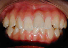 Z 5 BEFORE
